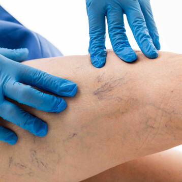 Eingriffe am venösen System