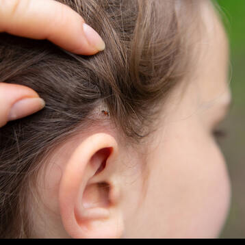 Insekten-/ Zeckenbiss