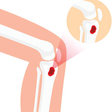 Knochennekrosen / Osteochondrosen